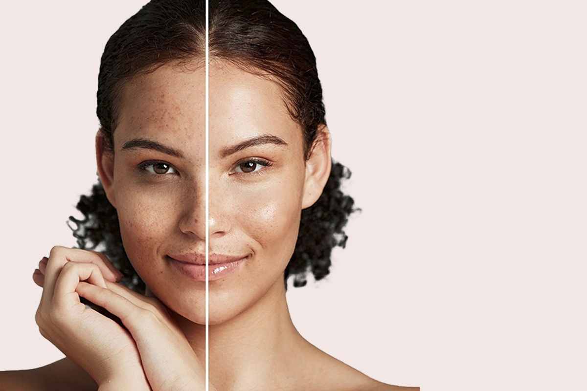 Acne & Scarring img