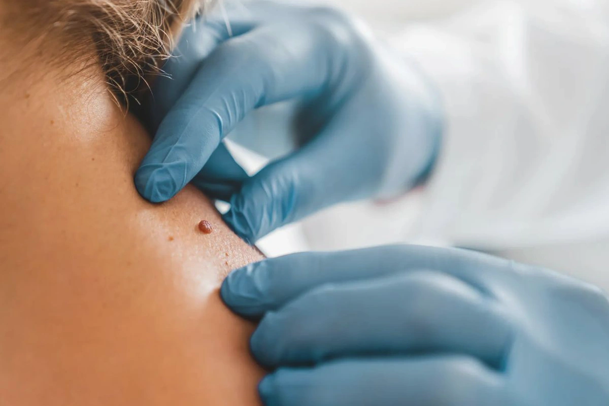 skin growths img